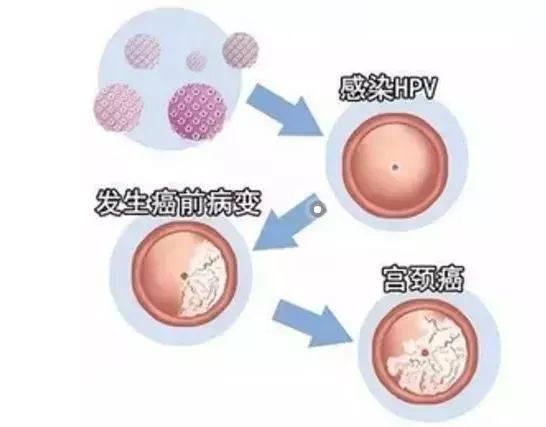 科学家实现HPV病毒重大突破，突破性研究引领新希望